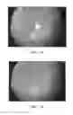 Fig. 14 - Removal of non-retinal opthalmic reflections in retinal imaging