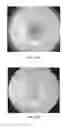 Fig. 16 - Removal of non-retinal opthalmic reflections in retinal imaging