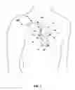 Fig. 02 - Assessing intra-cardiac activation patterns