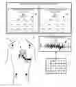 Fig. 01 - HIGH/LOW FREQUENCY SIGNAL QUALITY EVALUATIONS OF ECG LEAD SIGNALS