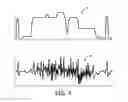 Fig. 06 - HIGH/LOW FREQUENCY SIGNAL QUALITY EVALUATIONS OF ECG LEAD SIGNALS