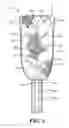 Fig. 04 - Pericardial balloon mapping