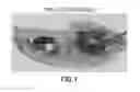 Fig. 02 - Apparatuses, systems and methods for detection of an ingested battery or magnet