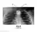 Fig. 07 - Apparatuses, systems and methods for detection of an ingested battery or magnet