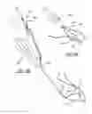 Fig. 10 - Non-sliding soft anchor