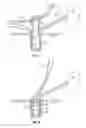 Fig. 06 - Suture anchor and associated methods of use