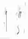 Fig. 22 - Suture capturing device for use in arthroscopic procedures