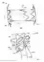 Fig. 03 - Anastomosis devices