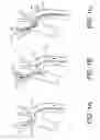 Fig. 02 - Methods of intracerebral implant delivery