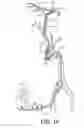 Fig. 05 - Methods of intracerebral implant delivery