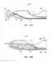 Fig. 30 - Methods of intracerebral implant delivery