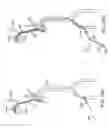 Fig. 37 - Methods of intracerebral implant delivery