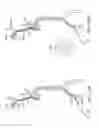 Fig. 40 - Methods of intracerebral implant delivery