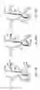 Fig. 45 - Methods of intracerebral implant delivery