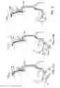 Fig. 47 - Methods of intracerebral implant delivery