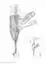 Fig. 77 - Arthroscopic surgical device