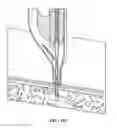 Fig. 117 - Pixel array medical systems, devices and methods