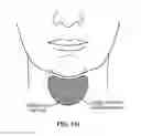 Fig. 130 - Pixel array medical systems, devices and methods
