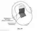 Fig. 38 - Pixel array medical systems, devices and methods