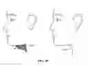 Fig. 85 - Pixel array medical systems, devices and methods