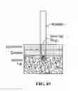 Fig. 87 - Pixel array medical systems, devices and methods