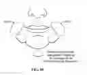 Fig. 89 - Pixel array medical systems, devices and methods