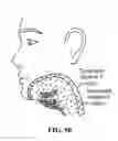 Fig. 90 - Pixel array medical systems, devices and methods