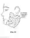 Fig. 91 - Pixel array medical systems, devices and methods