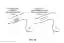 Fig. 94 - Pixel array medical systems, devices and methods