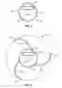 Fig. 06 - Device and method for centering and crossing a vascular occlusion