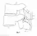 Fig. 02 - Interspinous spacers and associated methods of use and manufacture