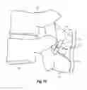 Fig. 20 - Interspinous spacers and associated methods of use and manufacture