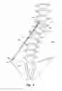 Fig. 04 - Device and method for treatment of spinal deformity