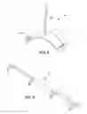 Fig. 10 - Ankle replacement system and method