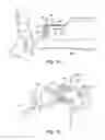 Fig. 15 - Ankle replacement system and method