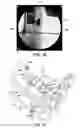 Fig. 18 - Ankle replacement system and method