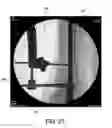 Fig. 20 - Ankle replacement system and method