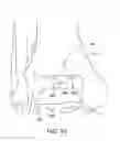 Fig. 38 - Ankle replacement system and method