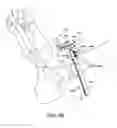 Fig. 46 - Ankle replacement system and method
