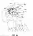 Fig. 60 - Ankle replacement system and method