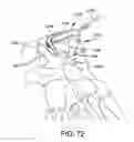 Fig. 67 - Ankle replacement system and method