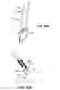 Fig. 78 - Ankle replacement system and method
