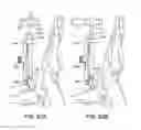Fig. 80 - Ankle replacement system and method
