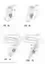 Fig. 05 - Partial cuff
