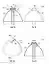 Fig. 09 - Ureteral stent and method