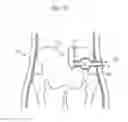 Fig. 113 - Apparatus for controlling flow in a bodily organ