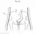 Fig. 114 - Apparatus for controlling flow in a bodily organ