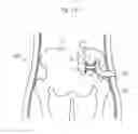 Fig. 115 - Apparatus for controlling flow in a bodily organ