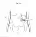 Fig. 116 - Apparatus for controlling flow in a bodily organ