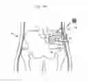Fig. 121 - Apparatus for controlling flow in a bodily organ